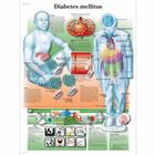 Lehrtafel - Diabetes mellitus, 4006857 [VR3441UU], Плакаты по метаболической системе