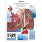 CODP Affezioni ostruttive polmonari croniche, 4006925 [VR4329UU], Éducation Tabac