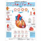 Infarto cardiaco, 4006927 [VR4342UU], Educación sobre salud y fitness cardiacos