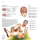 Epilessia, 4006960 [VR4626UU], Cerveau et système nerveux