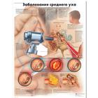 Медицинский плакат "Заболевания среднего уха", 1002247 [VR6252L], Oreja, Nariz, Garganta