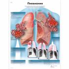 Медицинский плакат "Пневмония", 1002259 [VR6326L], Sistema Respiratorio