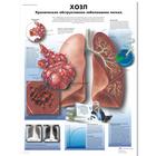 Медицинский плакат "ХОЗЛ - хроническое обструктивное заболевание легких", 1002262 [VR6329L], Système Respiratoire