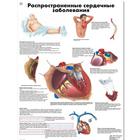 Медицинский плакат "Распространенные сердечные заболевания", 1002268 [VR6343L], Sistema Cardiovascular