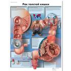 Медицинский плакат "Рак толстой кишки", 1002292 [VR6432L], Los tipos de cáncer