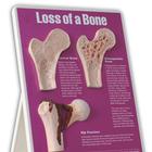 Loss of Bone Easel Display, 3004674 [W43124], Educación sobre artritis y osteoporosis