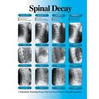 Spinal Decay Chart - Right Facing, Laminated, W57500, système Squelettique