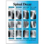 Spinal Decay Chart - Left Facing, Laminated, W57501, Sistema Esquelético